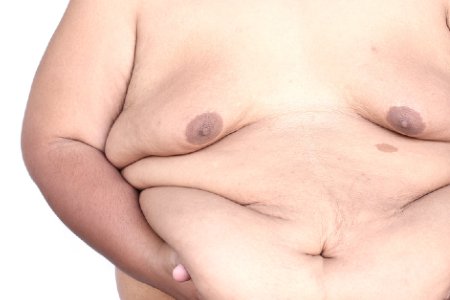 lipectomía-flor-lis