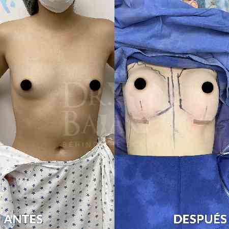 Breast Enlargement-2