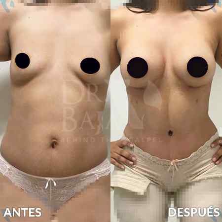Breast Enlargement-6