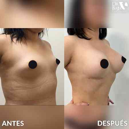 Breast Enlargement-11