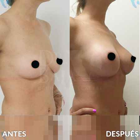 Breast Enlargement-12