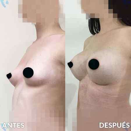 Breast Enlargement-13