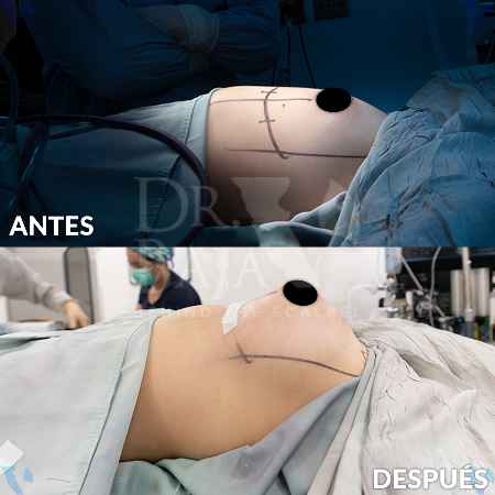 Aumento de Senos-15