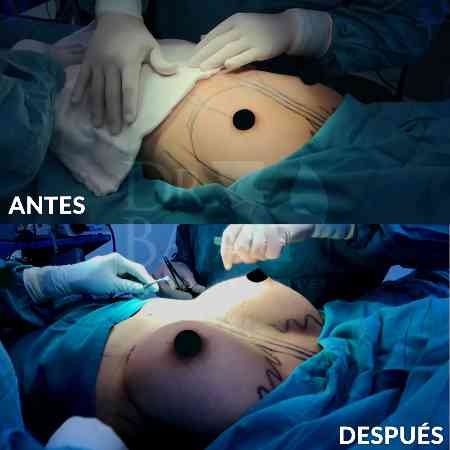 Breast Enlargement-21