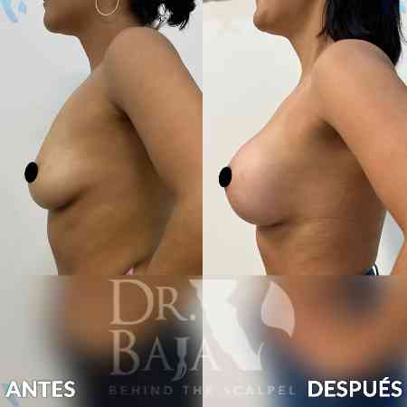 Breast Enlargement-23