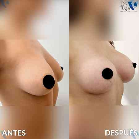 Breast Enlargement-27