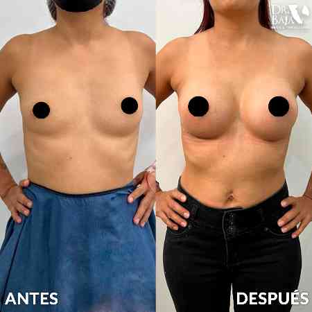 Breast Enlargement-29