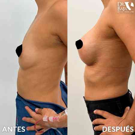 Breast Enlargement-30