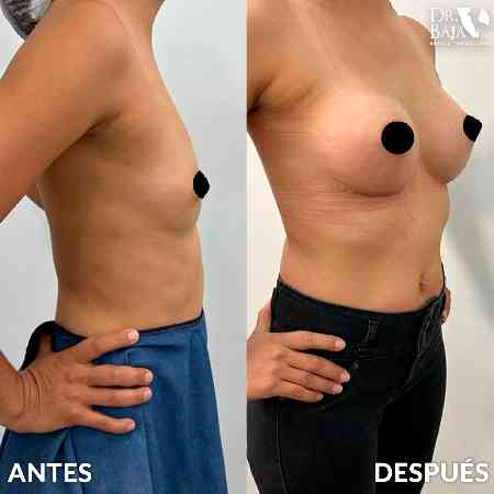 Breast Enlargement-31