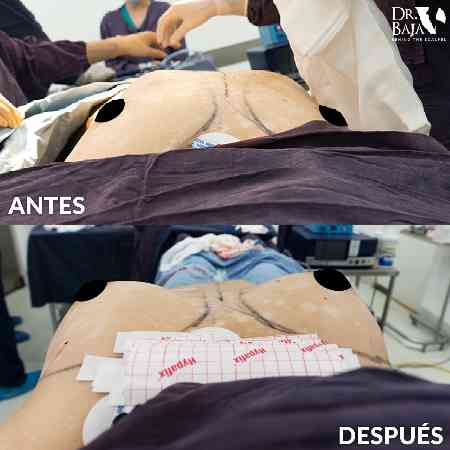 Breast Enlargement-32