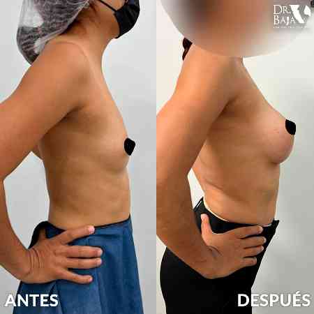 Breast Enlargement-35