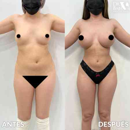Breast Enlargement-39