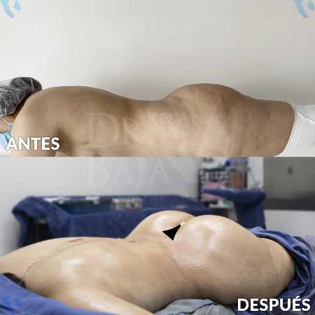 Transferencia de Grasa a Glúteos-2