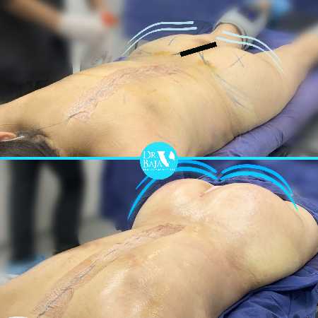 Transferencia de Grasa a Glúteos-3