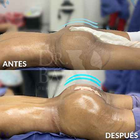 Brazilian Butt Lift-4