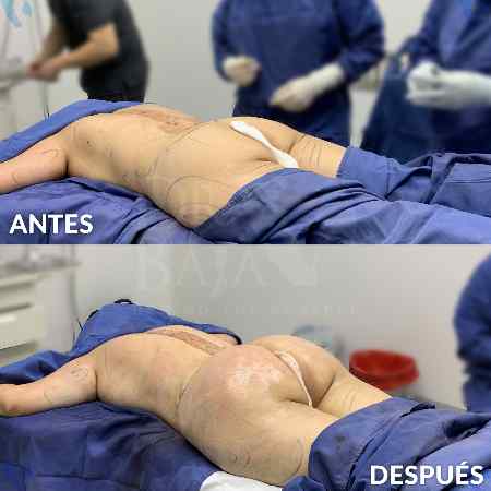 Brazilian Butt Lift-5