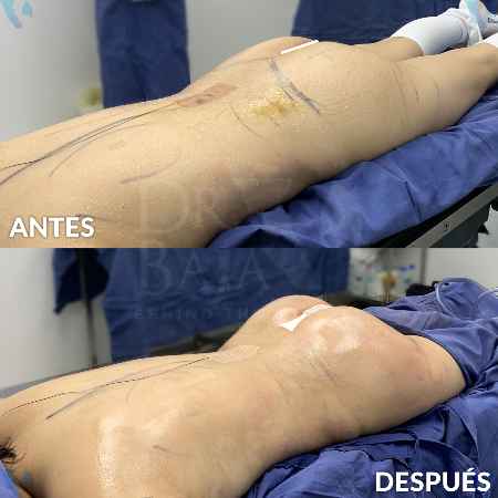 Brazilian Butt Lift-6