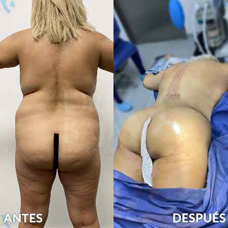 Brazilian Butt Lift-7