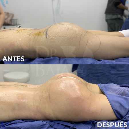 Transferencia de Grasa a Glúteos-8