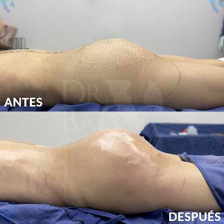 Brazilian Butt Lift-9