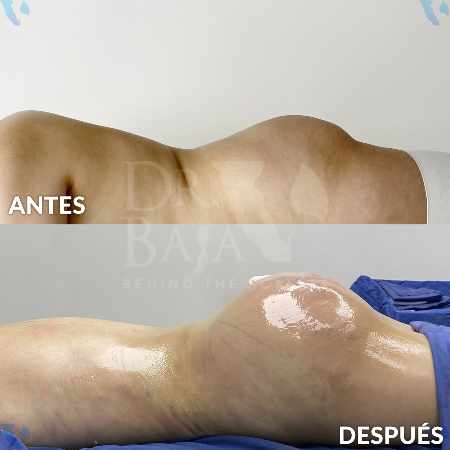 Brazilian Butt Lift-12