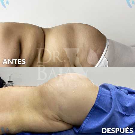 Brazilian Butt Lift-14