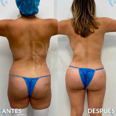 Transferencia de Grasa a Glúteos-17