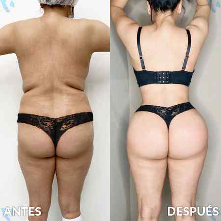 Brazilian Butt Lift-20