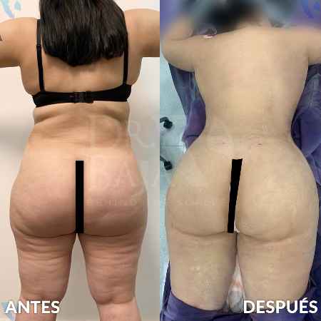 Transferencia de Grasa a Glúteos-21