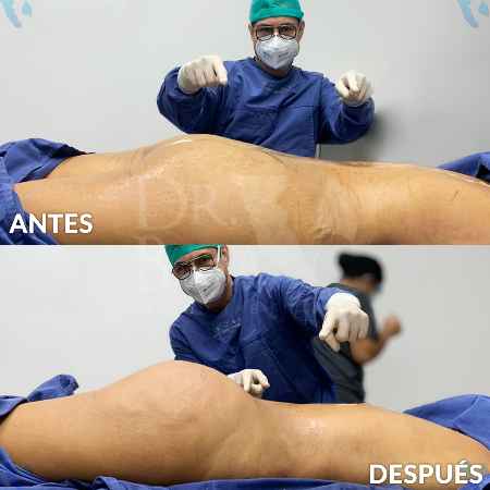 Transferencia de Grasa a Glúteos-23