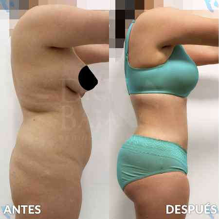 Transferencia de Grasa a Glúteos-24