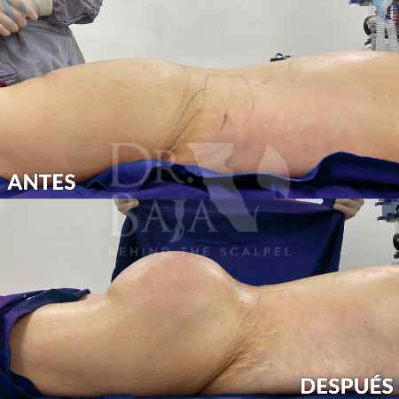 Transferencia de Grasa a Glúteos-25