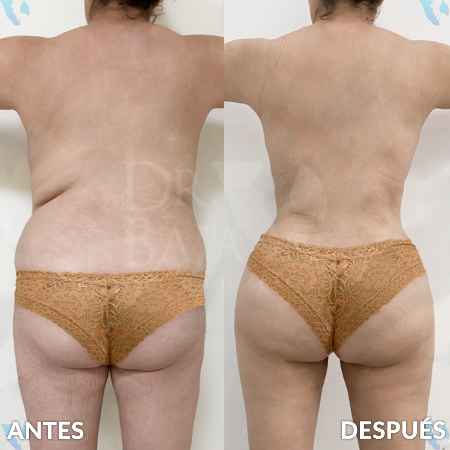 Brazilian Butt Lift-28