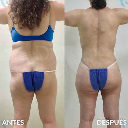 Transferencia de Grasa a Glúteos-29