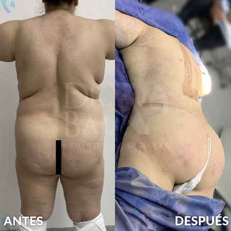 Transferencia de Grasa a Glúteos-30