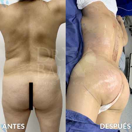 Transferencia de Grasa a Glúteos-31