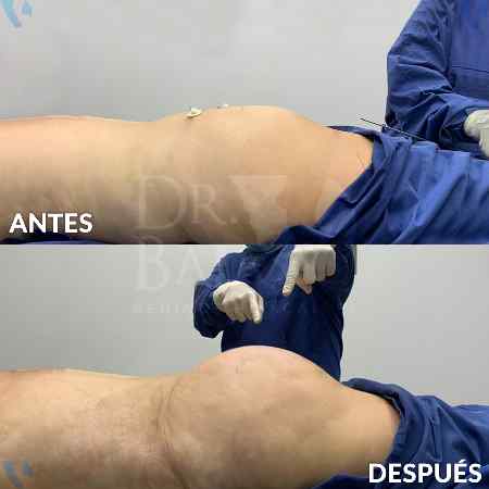 Transferencia de Grasa a Glúteos-34