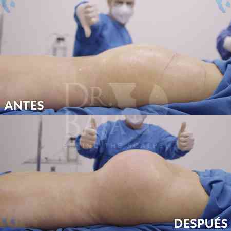 Brazilian Butt Lift-35