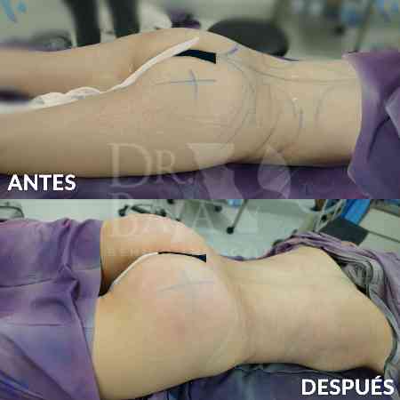 Transferencia de Grasa a Glúteos-36