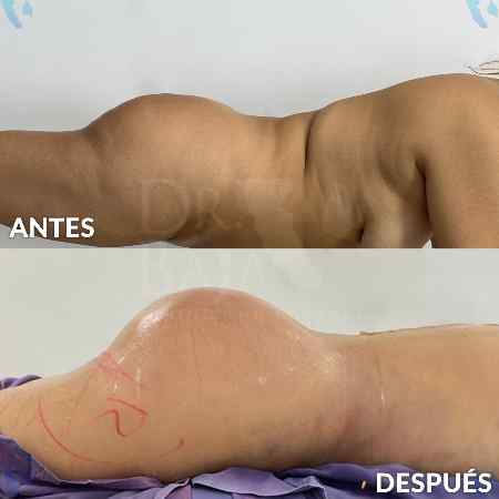 Transferencia de Grasa a Glúteos-37