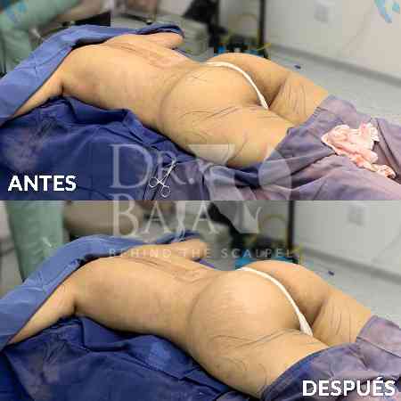 Transferencia de Grasa a Glúteos-38