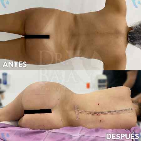 Transferencia de Grasa a Glúteos-42