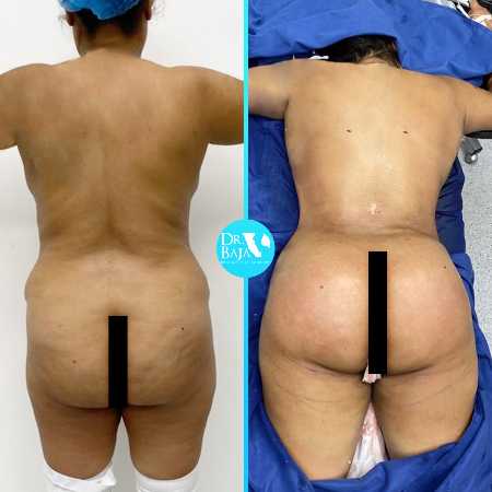 Brazilian Butt Lift-46