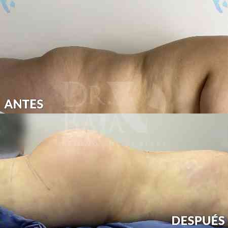 Transferencia de Grasa a Glúteos-51