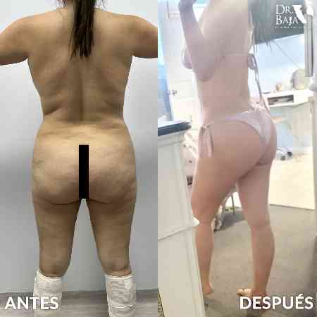 Brazilian Butt Lift-54