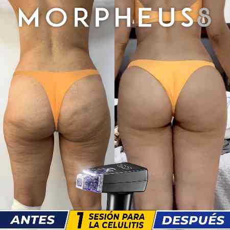 Transferencia de Grasa a Glúteos-55