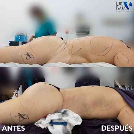 Brazilian Butt Lift-56