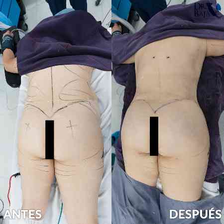 Transferencia de Grasa a Glúteos-57