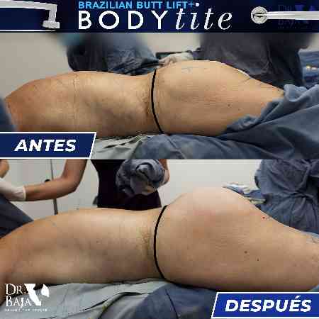 Transferencia de Grasa a Glúteos-59