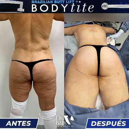 Brazilian Butt Lift-60